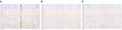 ATP1A1 de novo Mutation-Related Disorders: Clinical and Genetic Features